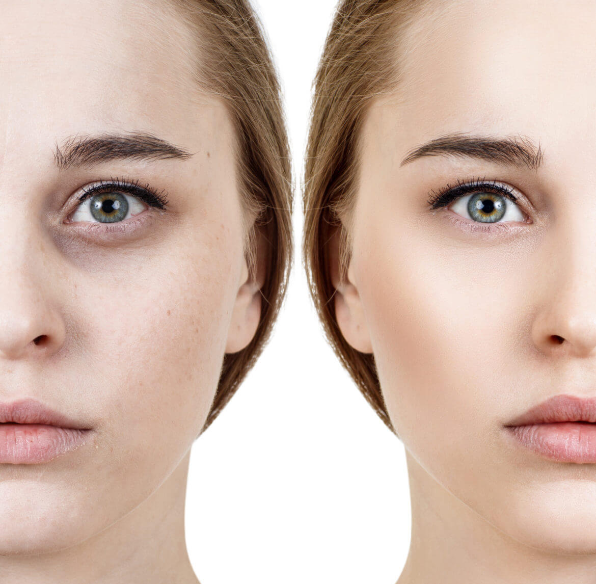 Procedures That Remove Dark Circles and Puffy Eyes Body Contouring Procedures